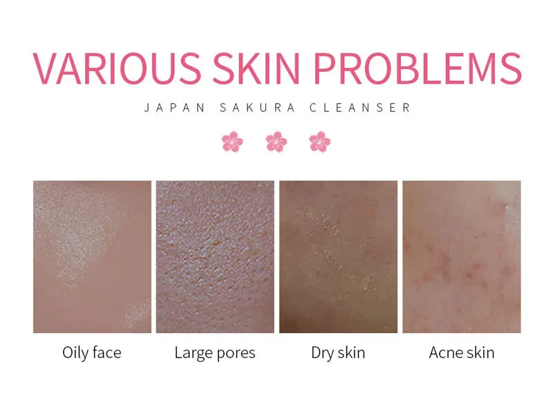 Limpiador Facial para Acné y Control de Aceite - Elimina Puntos Negros, Reduce Poros y Manchas Oscuras con Ácidos Aminados